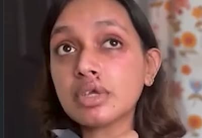 ബെംഗളൂരുവിൽ റാപ്പിഡോ അപകടത്തിൽ ഗുരുതര പരിക്കേറ്റ കോഴിക്കോട് സ്വദേശി സാനി കൃഷ്ണയോട് അനാസ്ഥ; രണ്ട് മാസം കഴിഞ്ഞിട്ടും തിരിഞ്ഞുനോക്കാതെ കമ്പനി